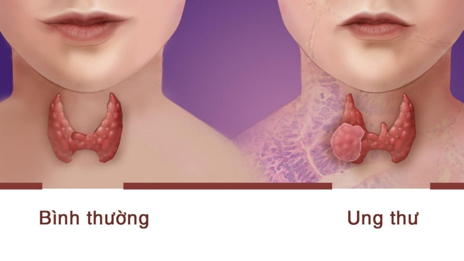 u tuyến giáp lành tính