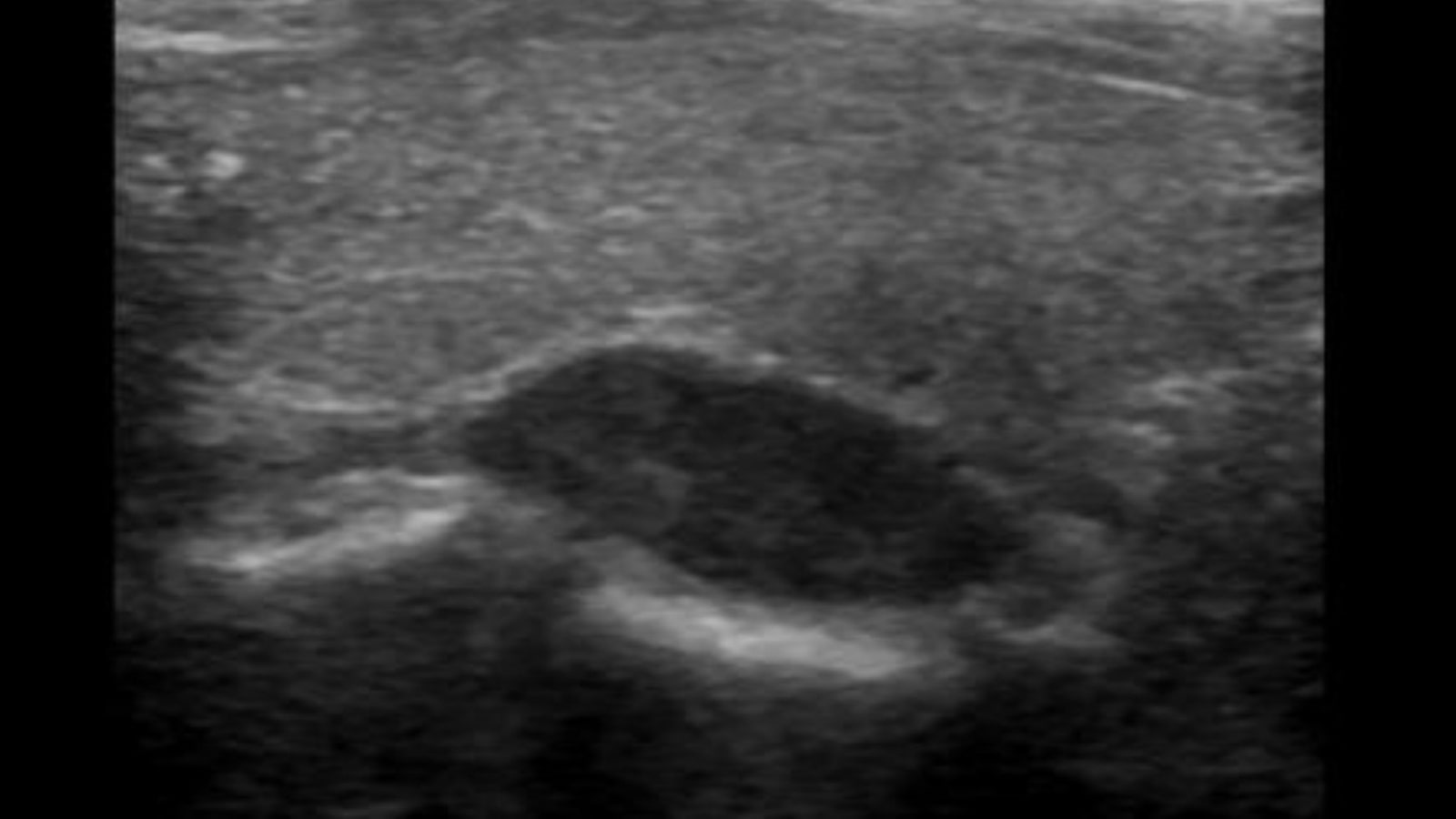 u tuyến giáp lành tính