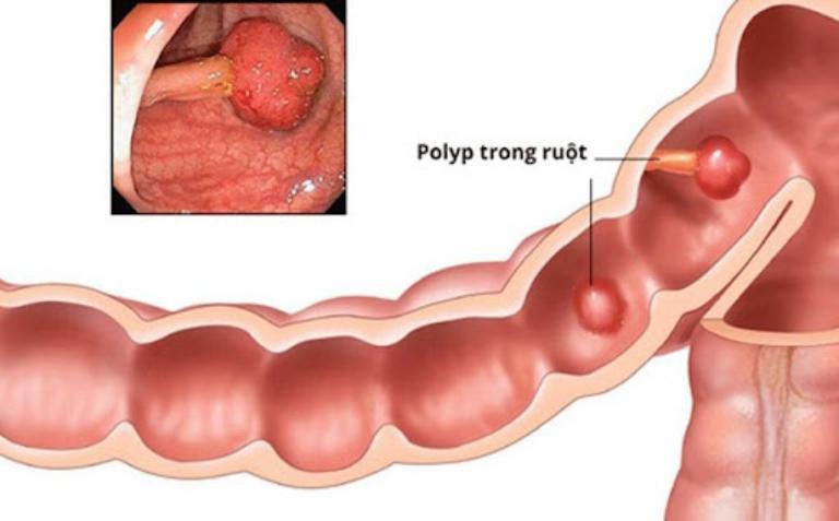 U đại tràng do polyp là gì?