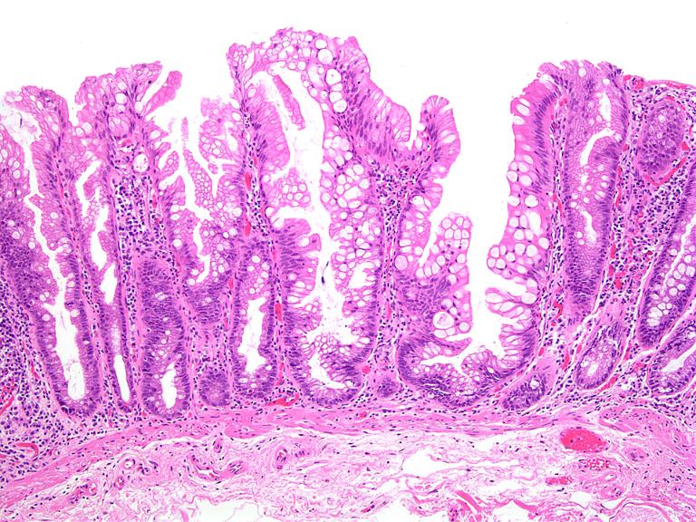 Polyp Răng Cưa