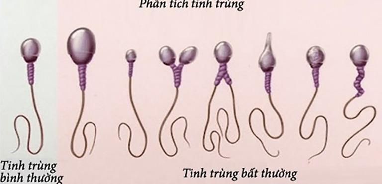 Tinh trùng dị dạng là gì?