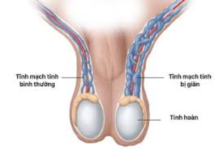 Giãn tĩnh mạch thừng tinh là gì