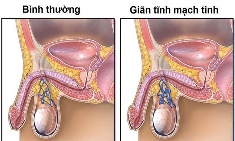 Nguyên nhân chính gây giản tĩnh mạch tinh
