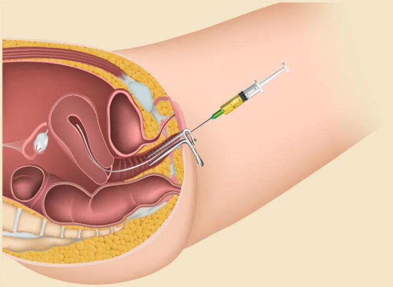 IVF Cho Tắc Vòi Trứng