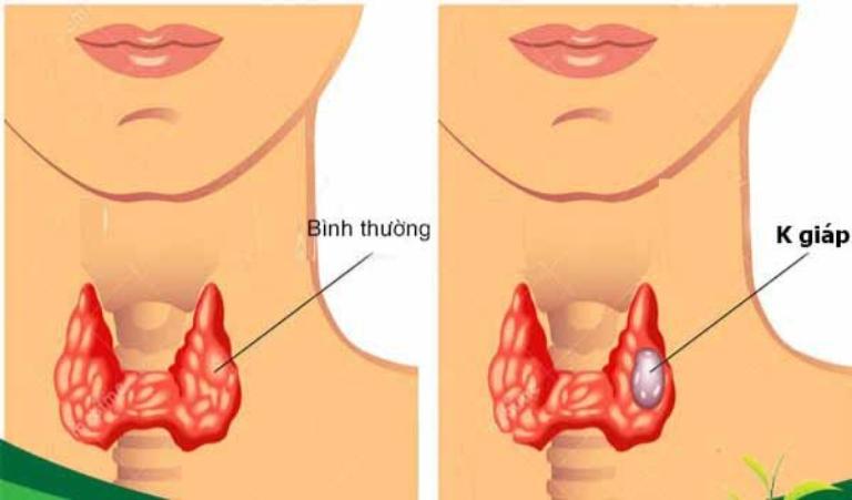 U tuyến giáp có tự hết không?