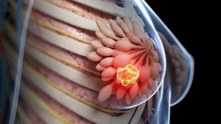 bài thuốc đông y trị u vú